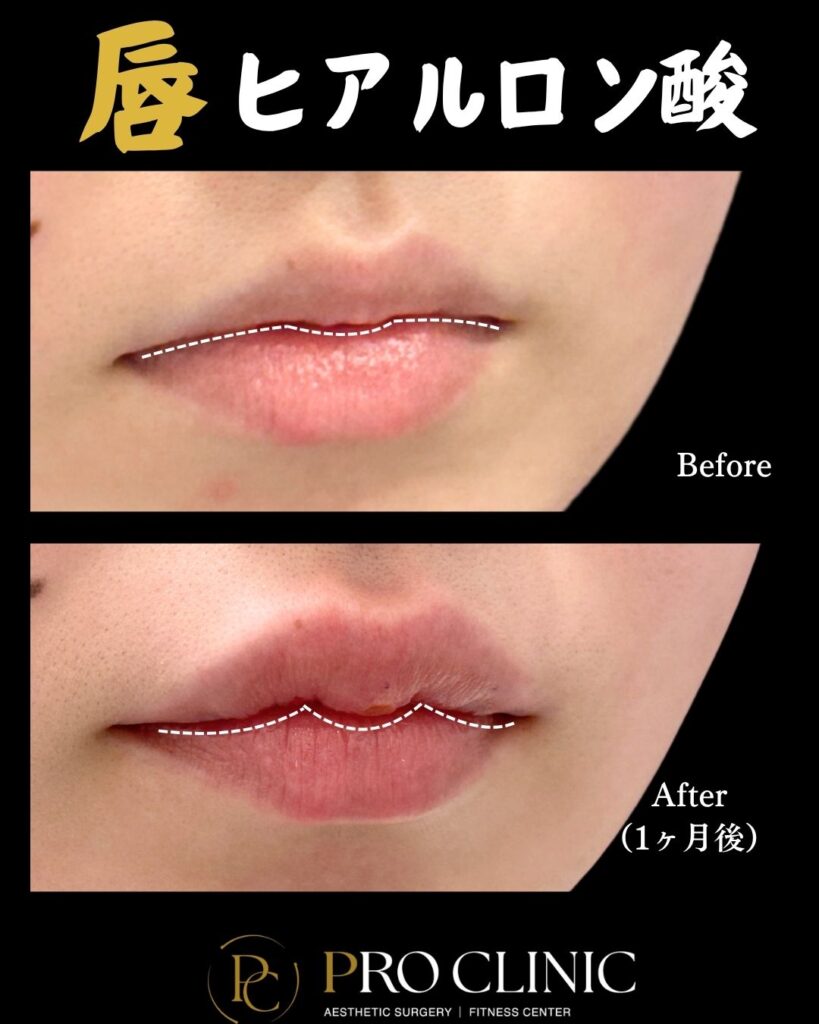 プロクリニックの唇ヒアルロン酸の症例（1ヶ月後・斜角）