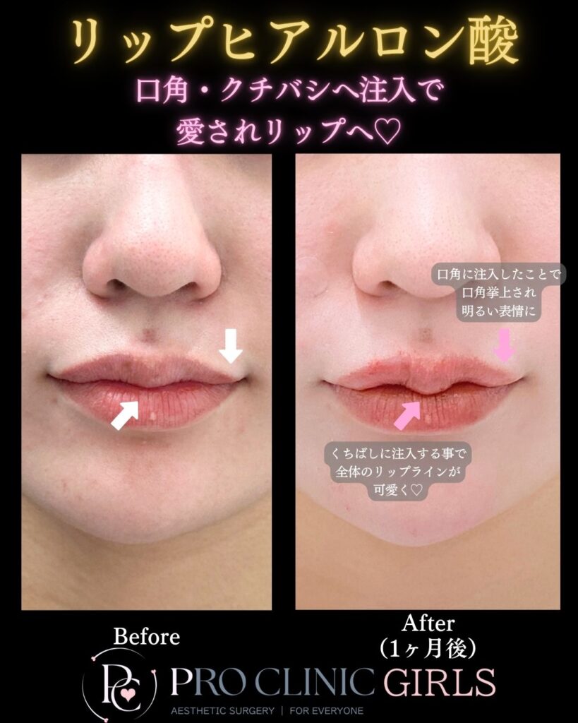 プロクリニックのリップヒアルロン酸の症例(1ヶ月後・正面)