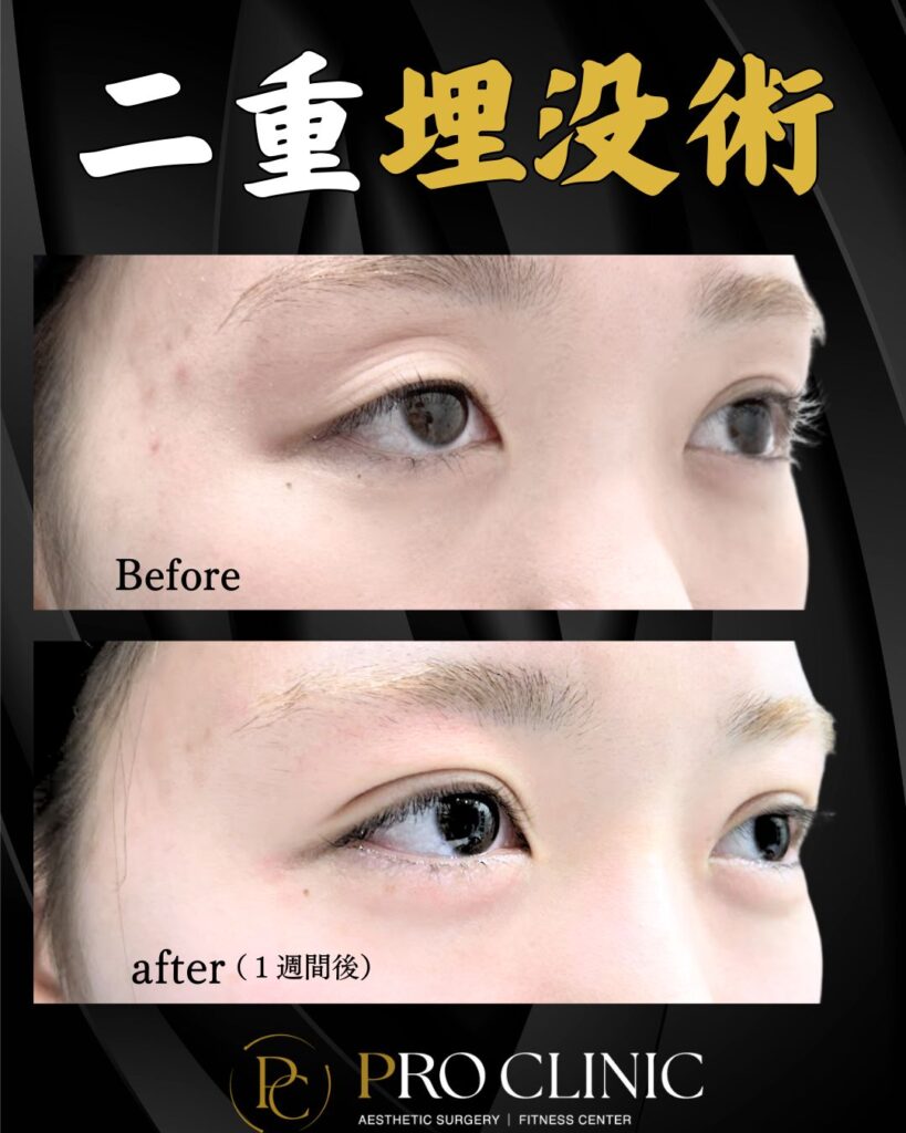 プロクリニックの二重形成埋没術の症例（１週間後・斜め）。片側が一重の術前（Before）と比べ、術後1週間で内出血や腫れが少なく、既に美しい二重ラインが確認できる目の変化とダウンタイムの経過。