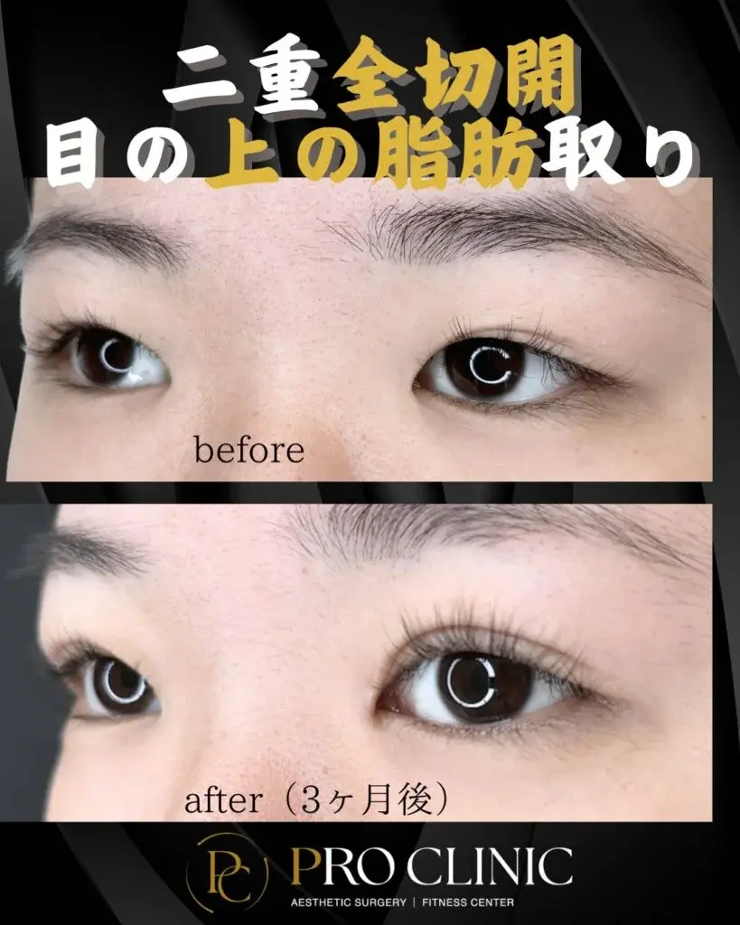 プロクリニックの二重形成術全切開法の症例（3か月後・斜角）