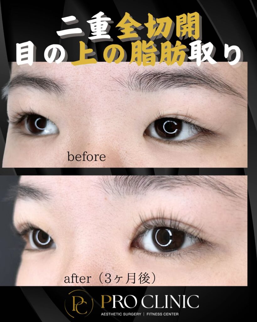 プロクリニックの二重形成術全切開法の症例（3か月後・斜角）