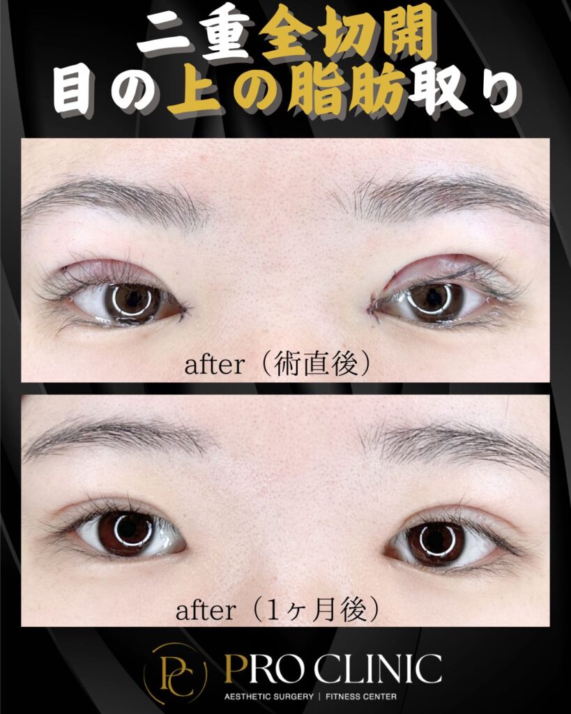 プロクリニックの二重全切開の症例（1か月後・正面）