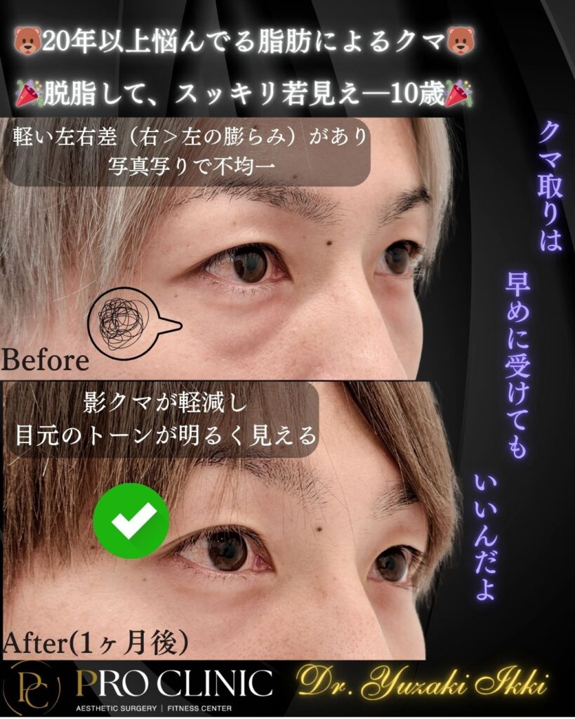 プロクリニックのクマ取り（脱脂）の症例（1ヶ月後・斜角）