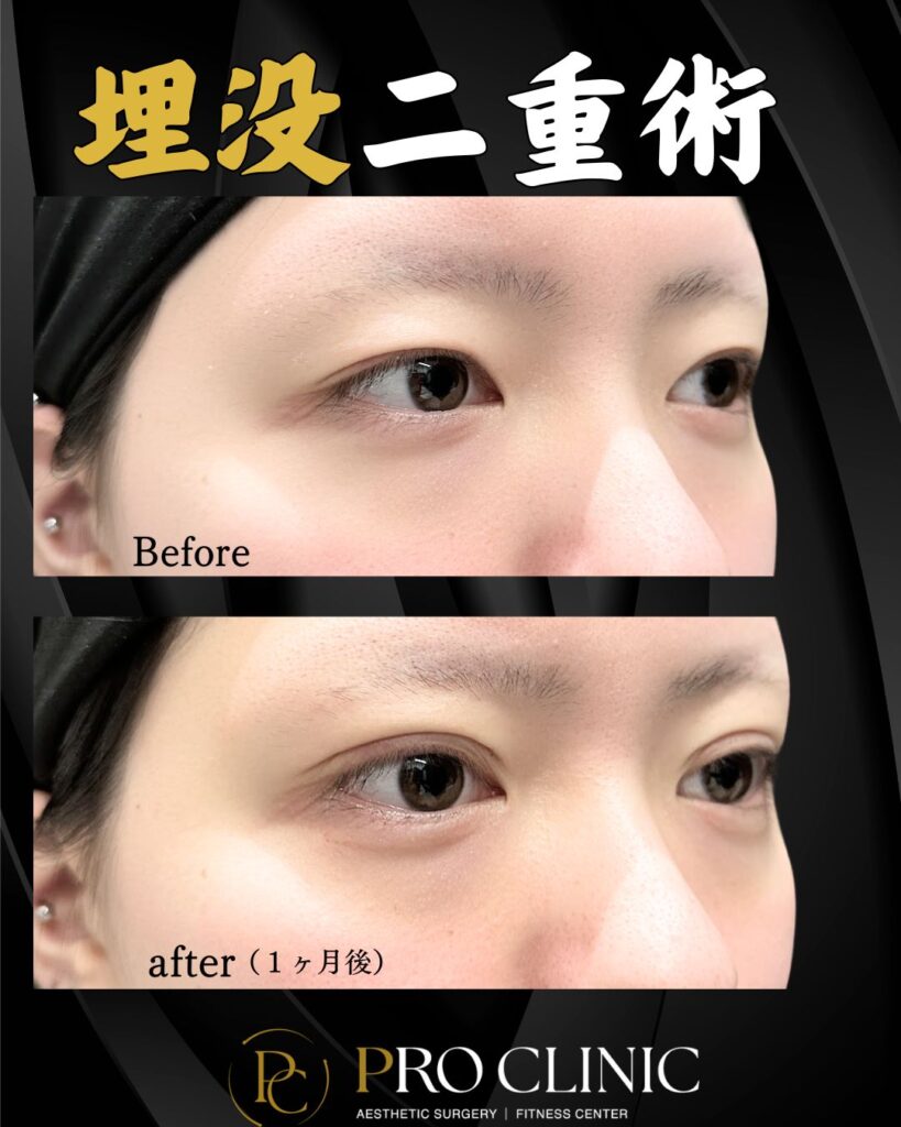 プロクリニックの埋没二重術の症例。一重の術前（Before）と比較すると、術後1ヶ月（after (1ヶ月後)）は目ヂカラがアップし、華やかな印象が増している。