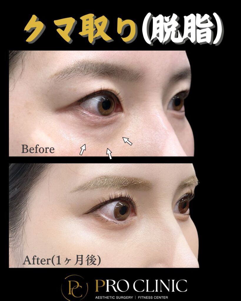 プロクリニックのクマ取り（脱脂）の症例（1ヶ月後・斜角）