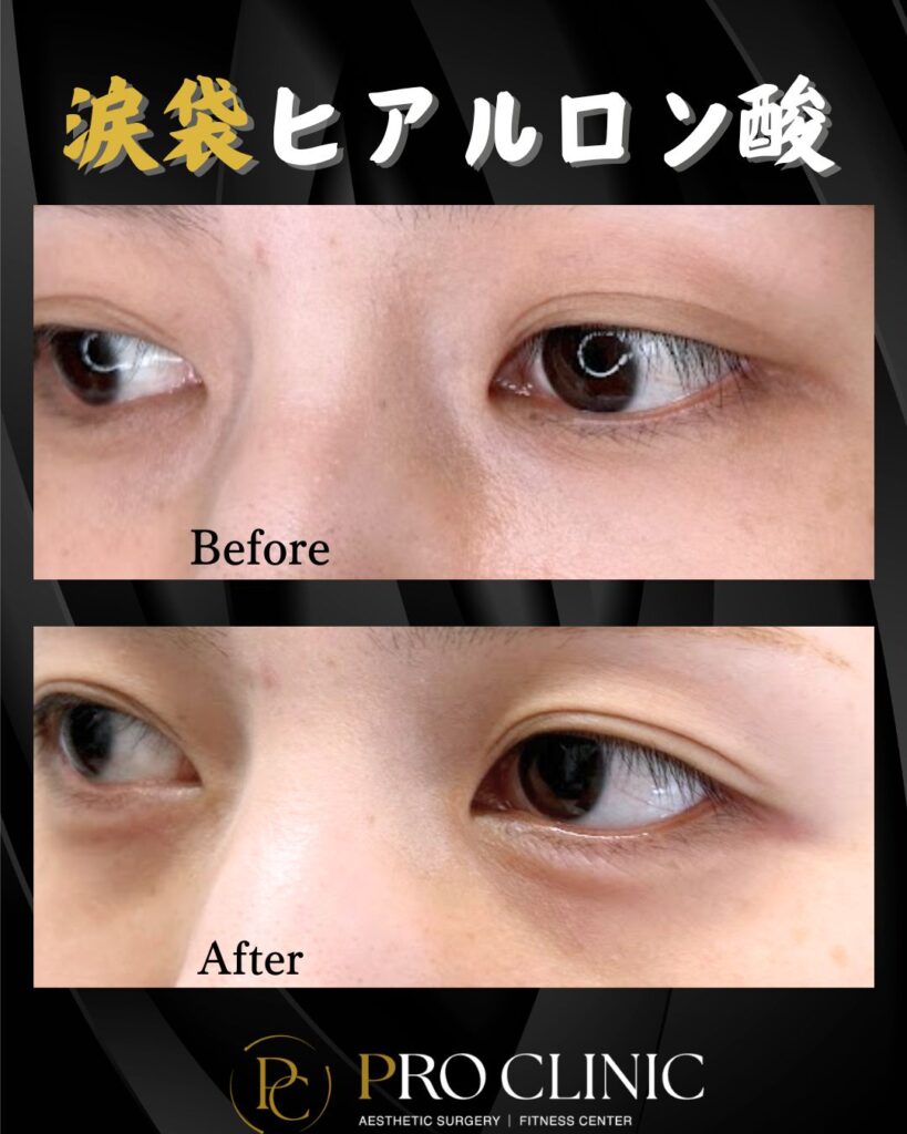 プロクリニックの涙袋ヒアルロン酸注入の症例（1か月後・斜角）