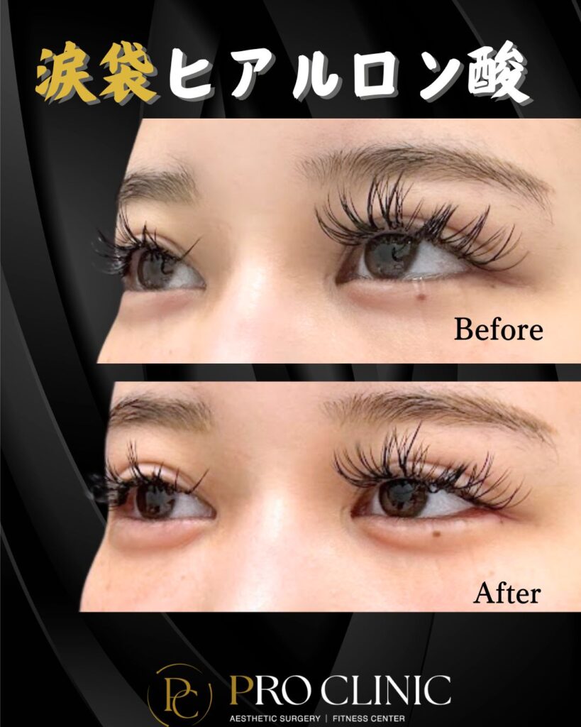 プロクリニックの涙袋ヒアルロン酸注入の症例（1か月後・斜角）