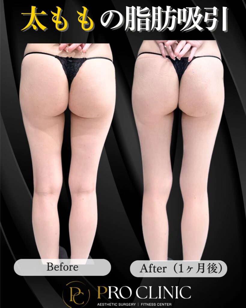 プロクリニックの3D脂肪豊胸術に伴う大腿部脂肪吸引の症例（１か月・背面）