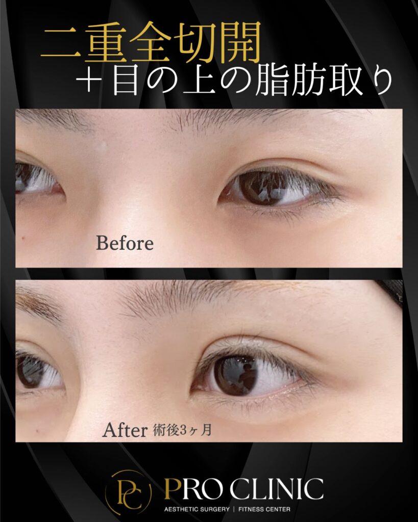 プロクリニックの二重形成術全切開法の症例（3か月後・斜角）