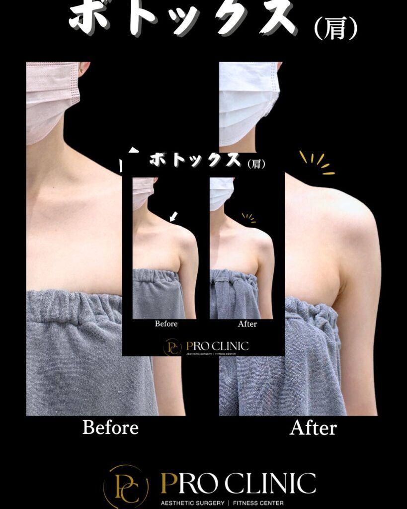 プロクリニックの肩ボトックスの症例（1ヶ月後・正面）