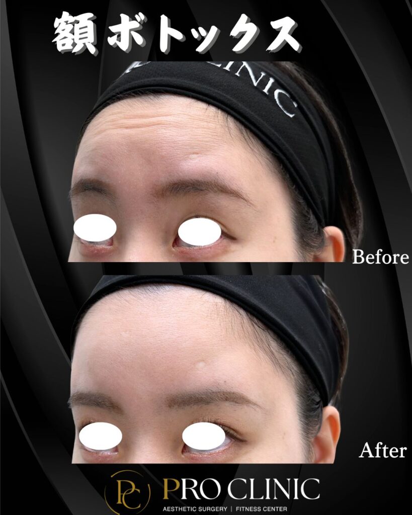 プロクリニックの額ボトックスの症例（1ヶ月後・斜角）