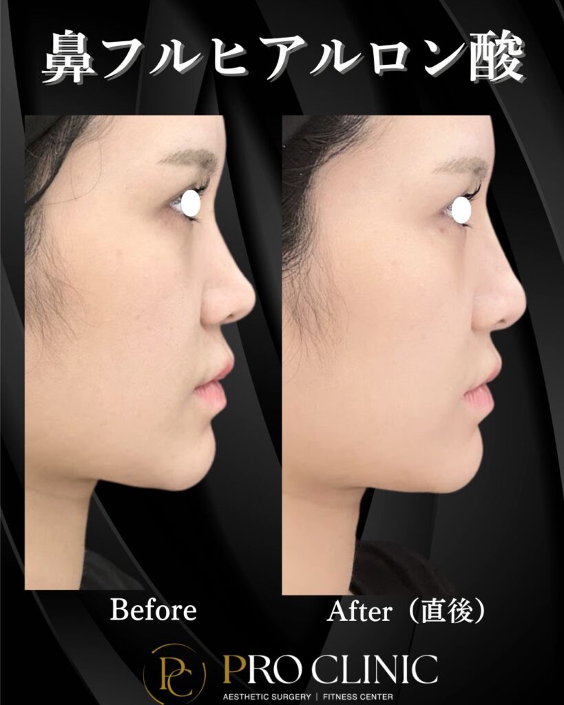 プロクリニックの鼻フルヒアルロン酸注入の症例（術後直後・側面）
