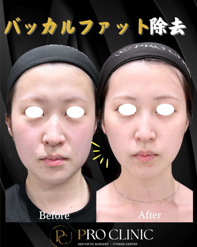 プロクリニックのバッカルファット除去の症例（1か月・正面）