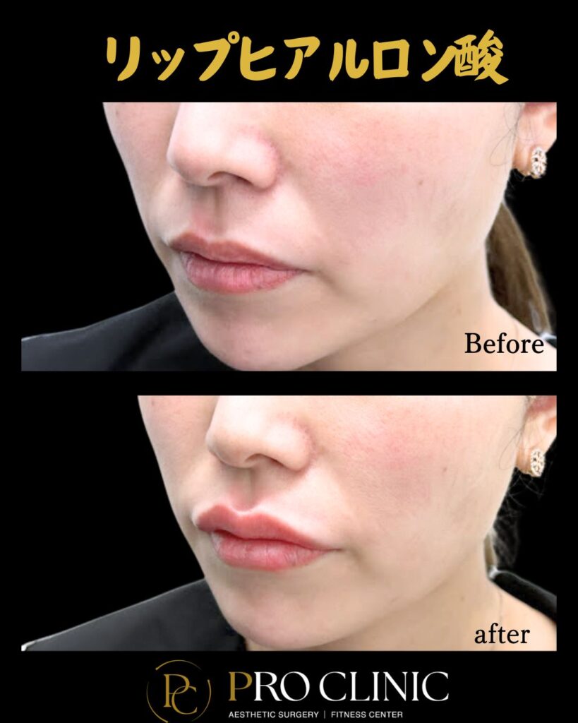 プロクリニックの唇ヒアルロン酸注入の症例（1か月後・斜角）