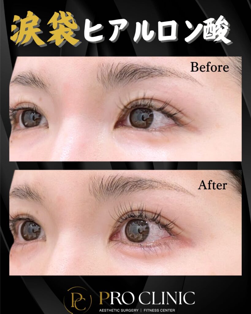 プロクリニックの涙袋ヒアルロン酸注入の症例（1か月後・斜角）