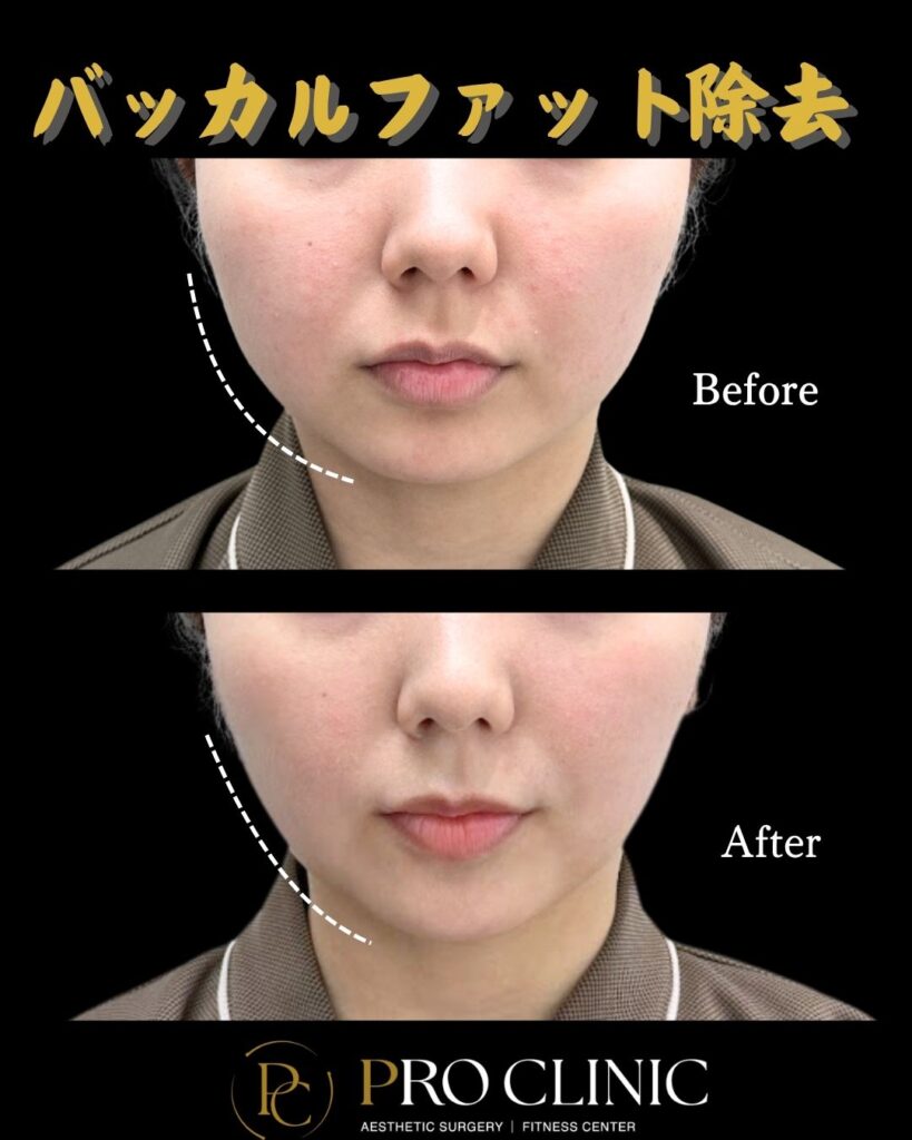 プロクリニックのバッカルファット除去の症例（1か月後・正面）