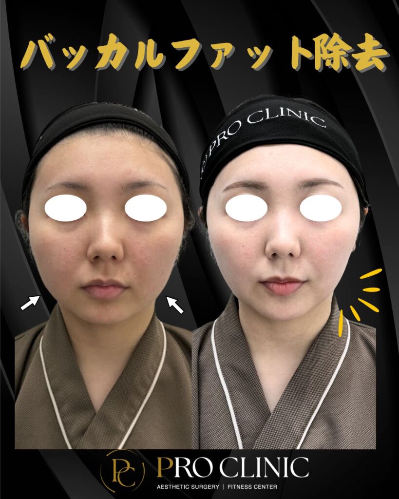 プロクリニックのバッカルファット除去の症例（3か月後・正面）