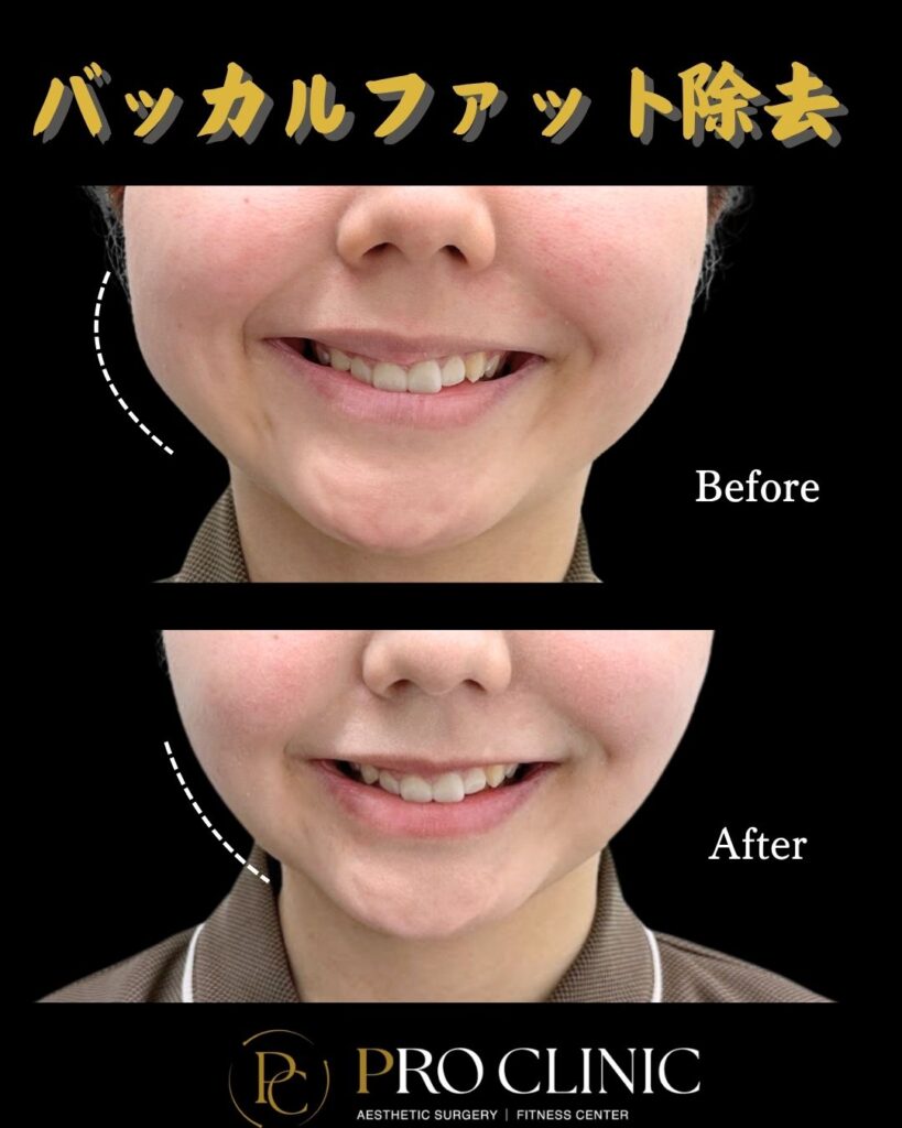 プロクリニックのバッカルファット除去の症例（1か月後・正面）