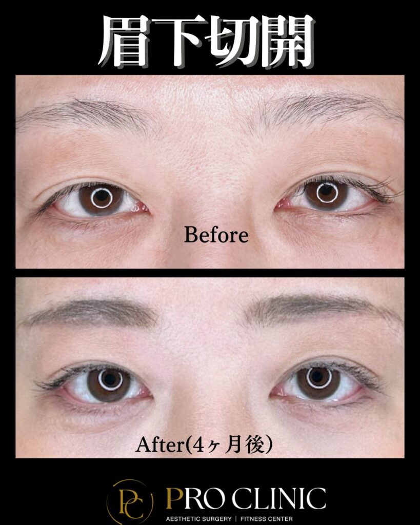 プロクリニックの眉下切開の症例（4か月後・正面）