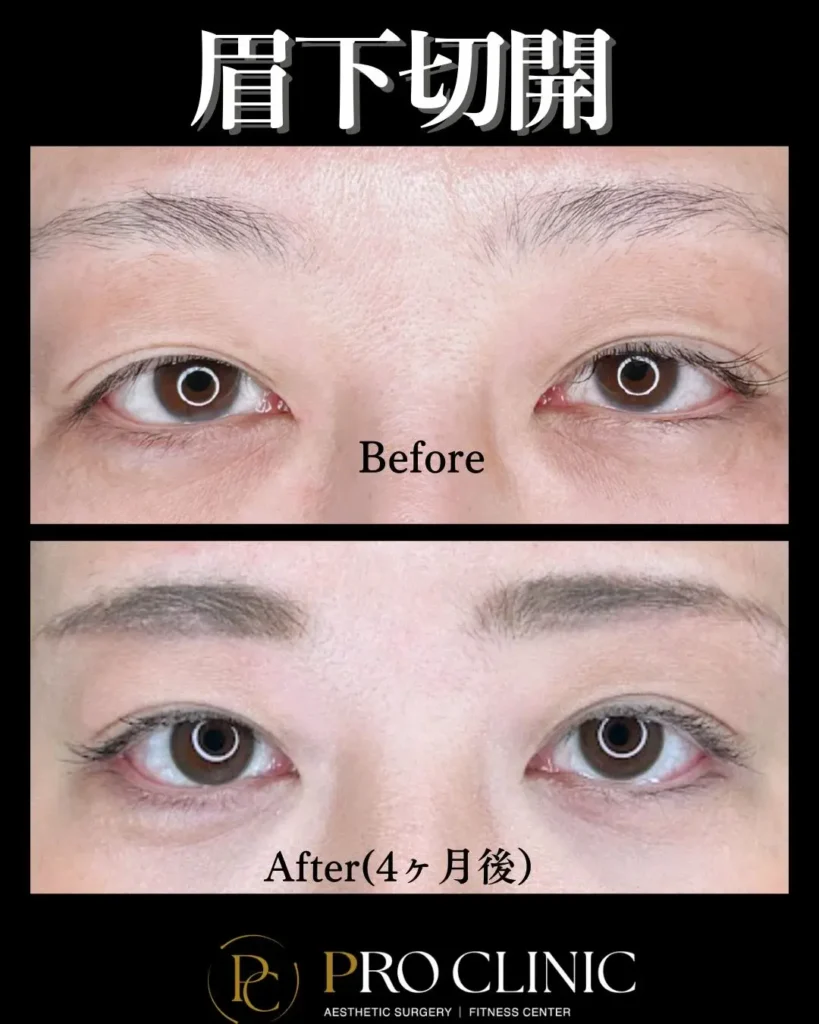 プロクリニックの眉下切開の症例（4か月後・正面）
