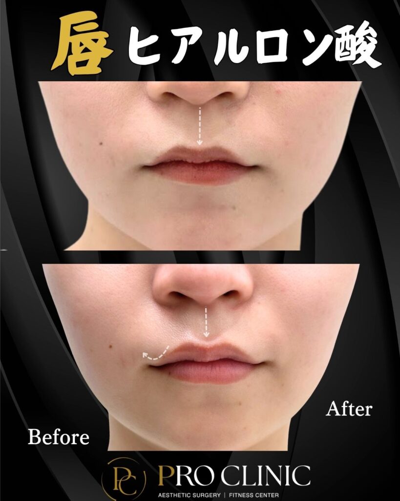 プロクリニックの唇ヒアルロン酸の症例(1ヶ月後・正面)