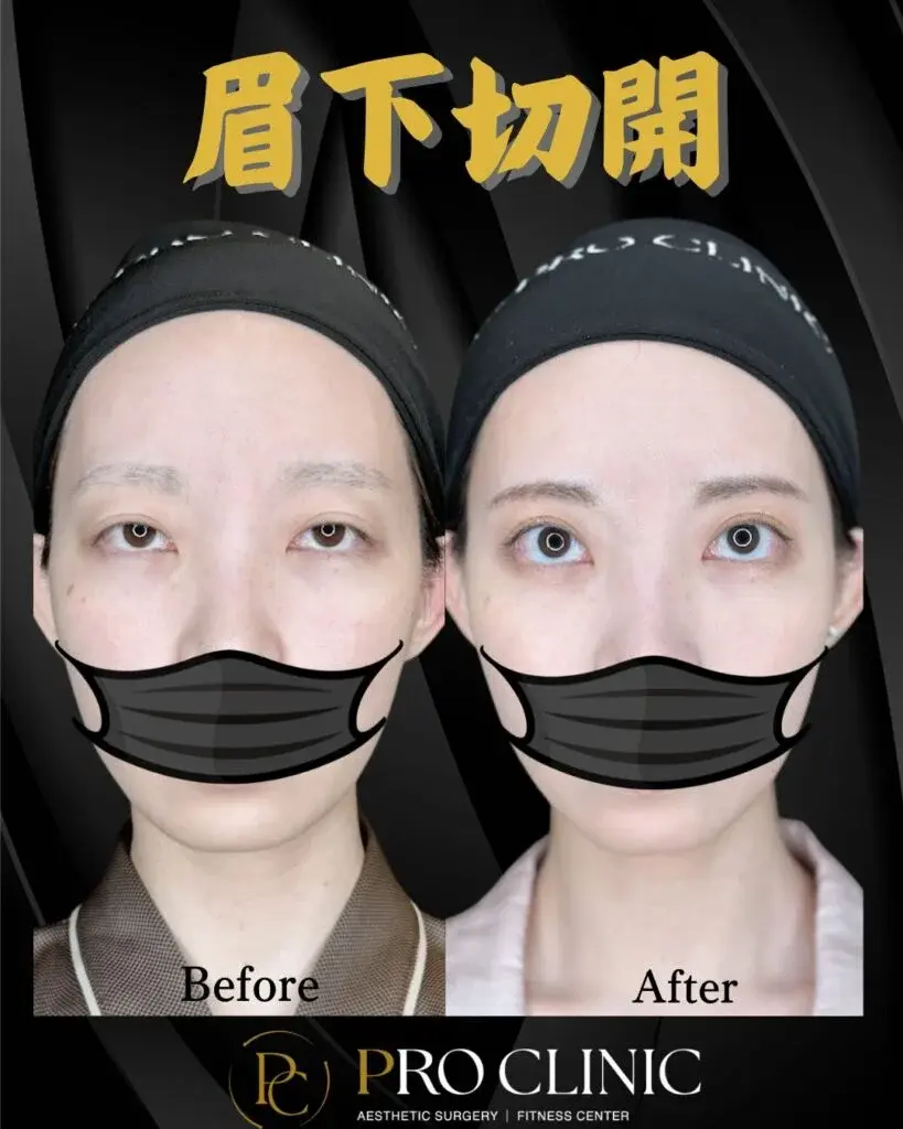 プロクリニックの眉下切開の症例（3か月後・正面）