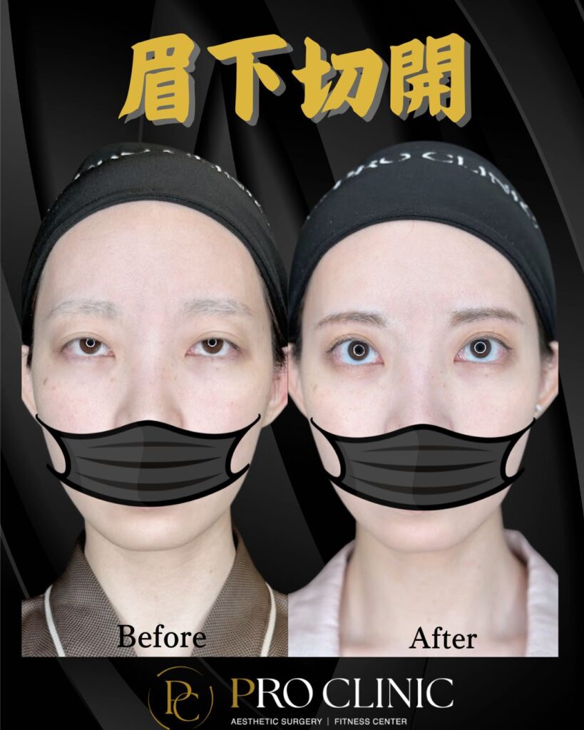 プロクリニックの眉下切開の症例（3か月後・正面）