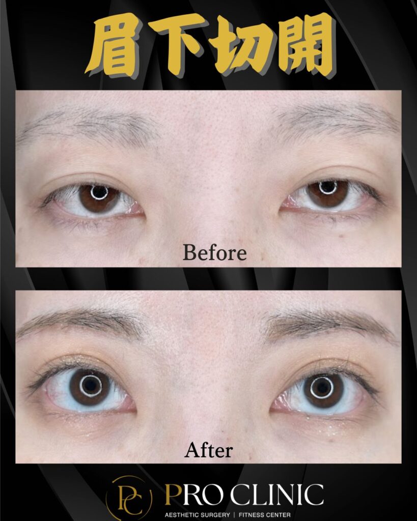 プロクリニックの眉下切開の症例（3か月後・正面）