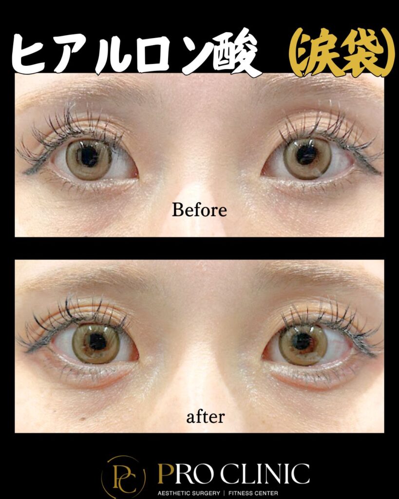 プロクリニックの涙袋ヒアルロン酸注入の症例（1か月後・正面）