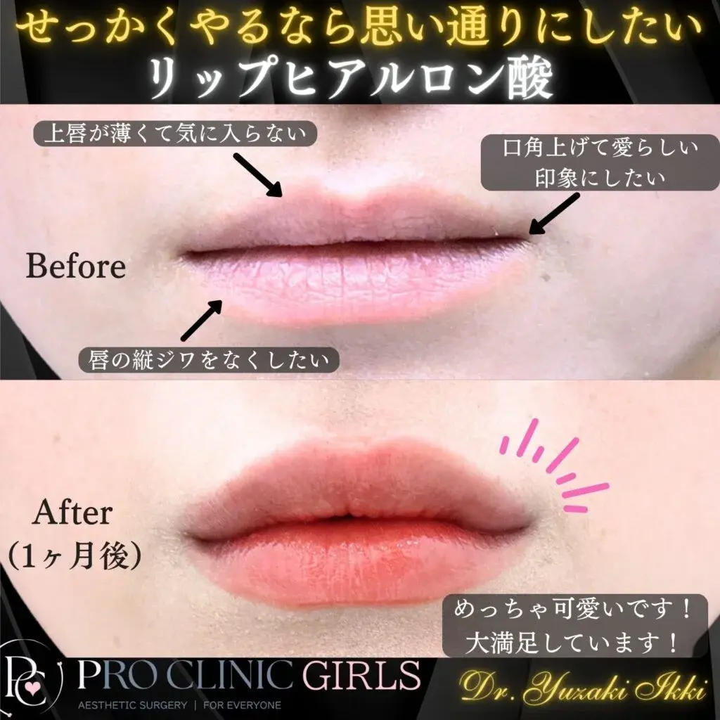 プロクリニックのリップヒアルロン酸注入の症例（1か月後・正面）