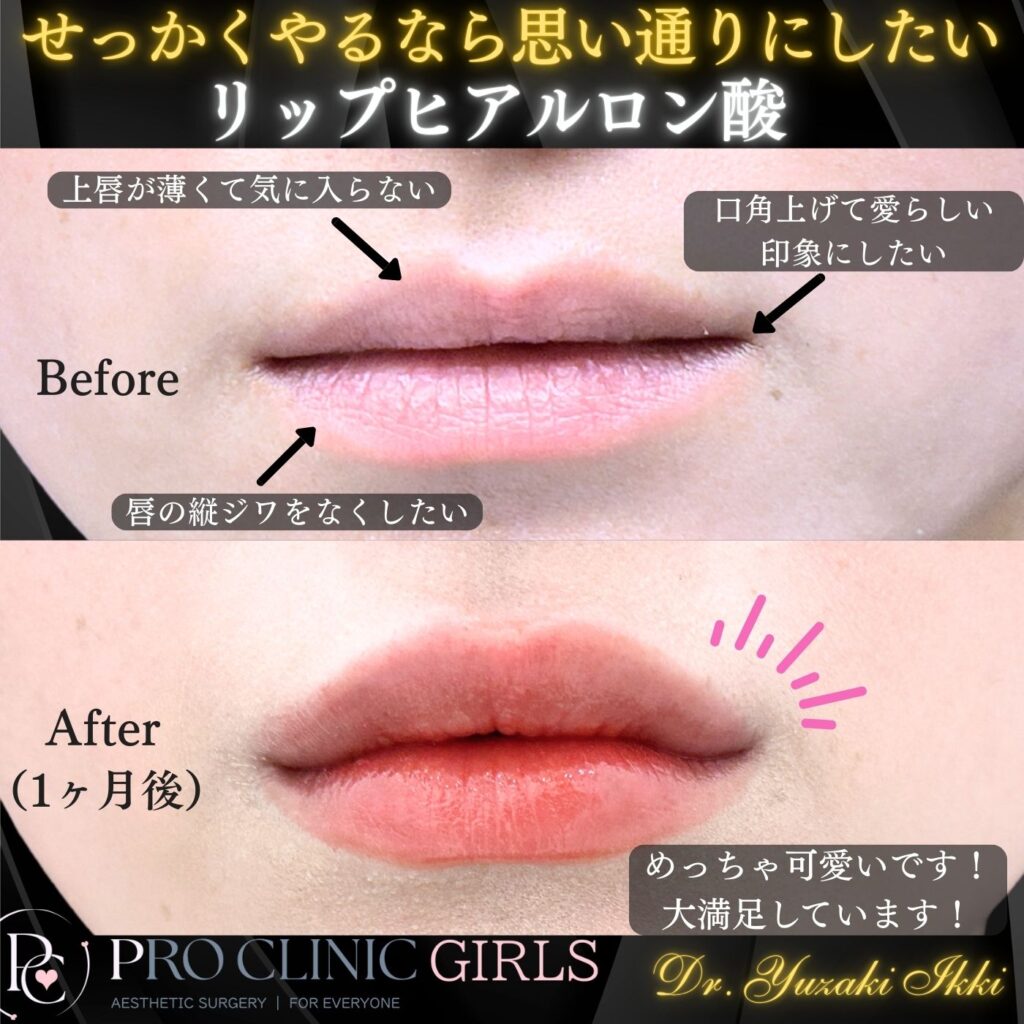 プロクリニックのリップヒアルロン酸注入の症例（1か月後・正面）