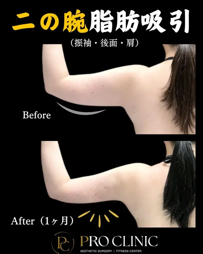 プロクリニックの二の腕の脂肪吸引の症例写真(1ヶ月後・背面)。施術前と比較すると、二の腕が全体的にボリュームダウンし、なだらかなシルエットとなっている。