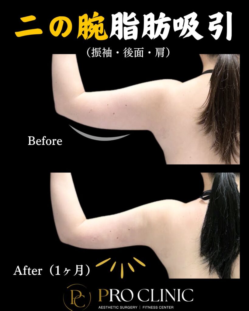 プロクリニックの二の腕の脂肪吸引の症例(1ヶ月後・背面)