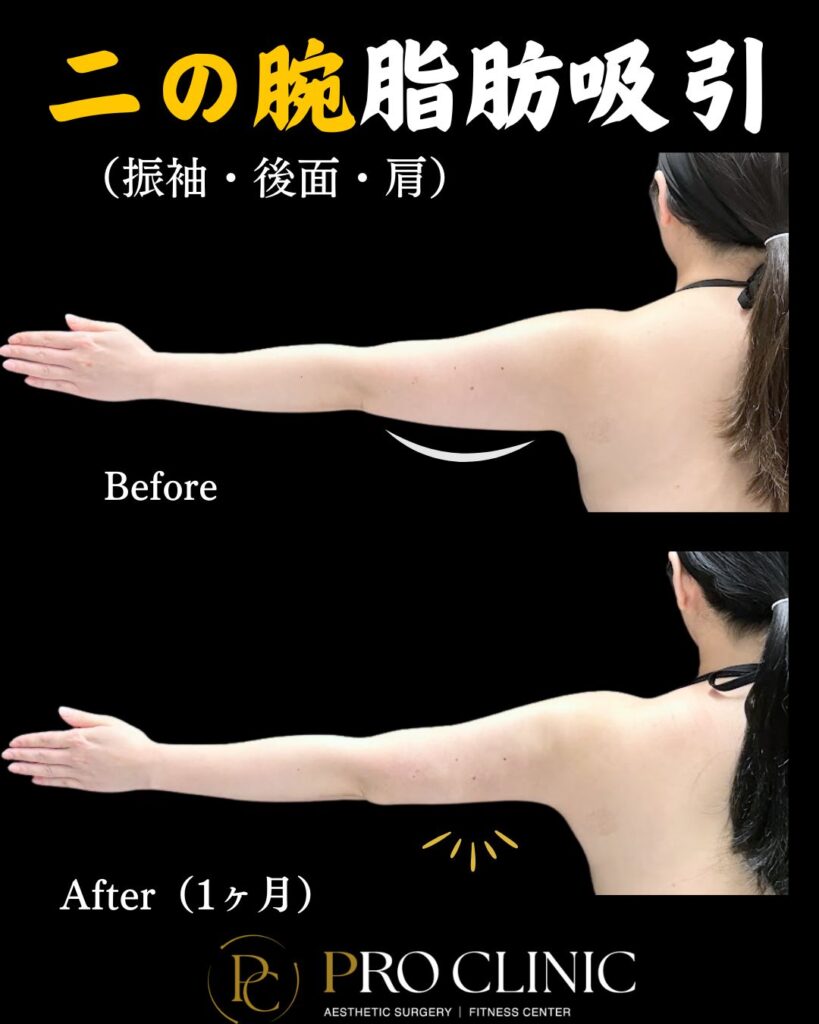 プロクリニックの二の腕の脂肪吸引の症例写真(1ヶ月後・背面)。