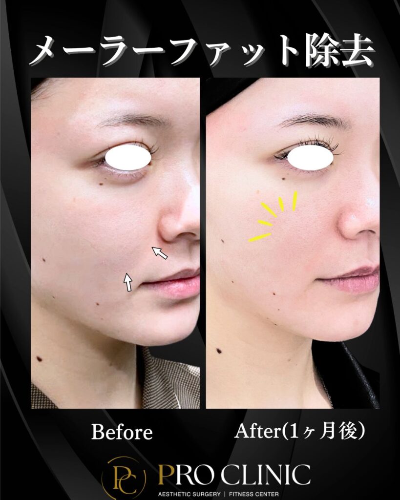 プロクリニックのメーラーファット除去の症例（1か月後・斜角）