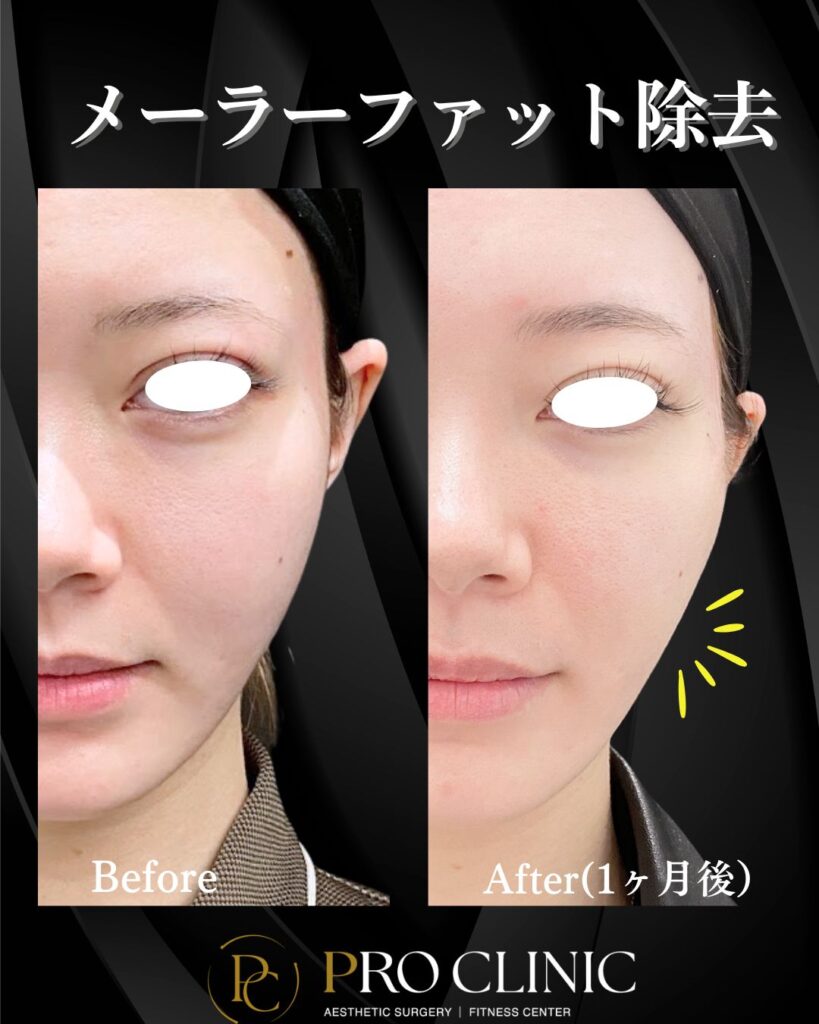 プロクリニックのメーラーファット除去の症例（1か月後・正面）