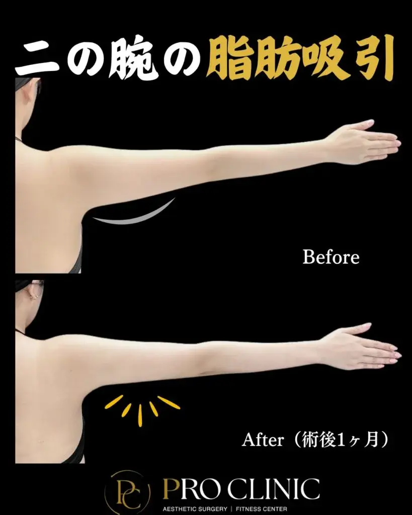 プロクリニックの二の腕の脂肪吸引の症例写真(術後1ヶ月・背面・右腕)。施術前が関節へと寄るにつれて膨らみが大きくなっていったのに対し、施術後は均一なボディラインへと変化している。