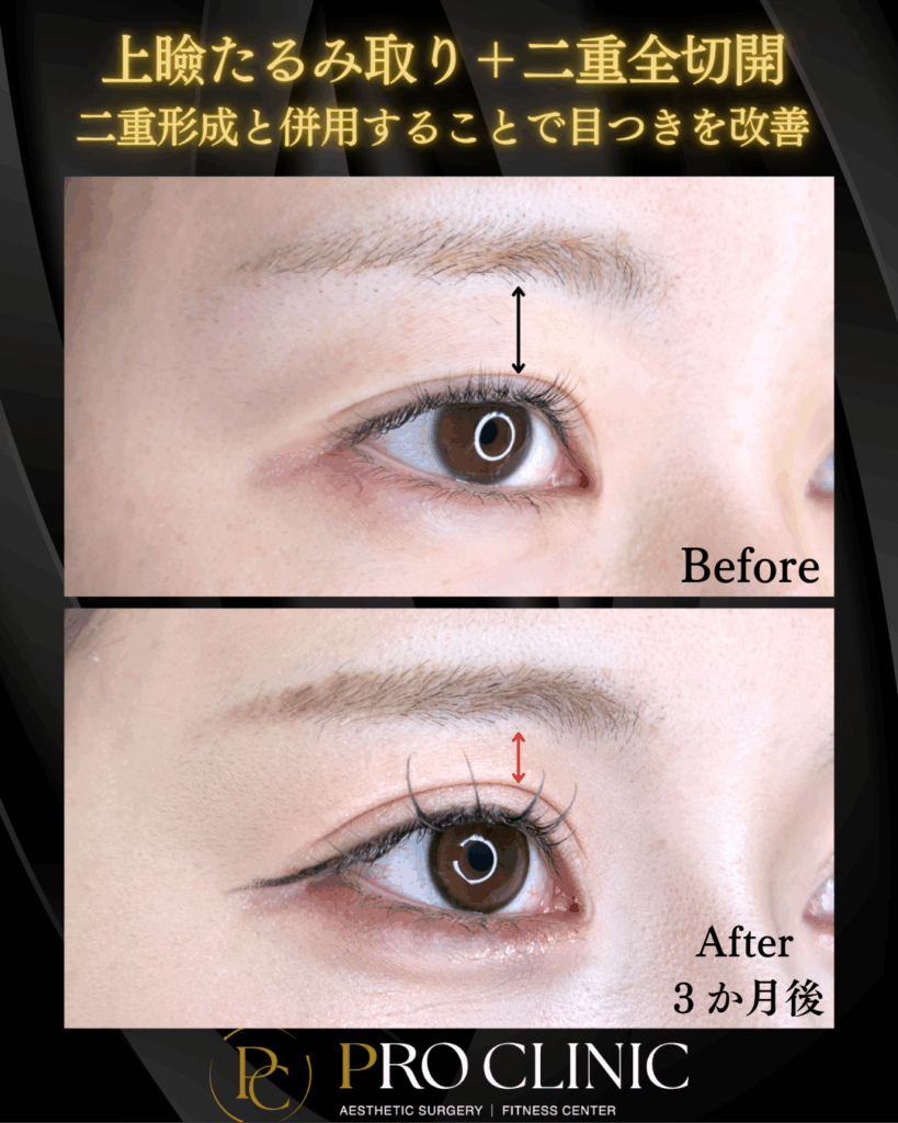 プロクリニックの上瞼たるみ取りの症例（3か月後・斜角）