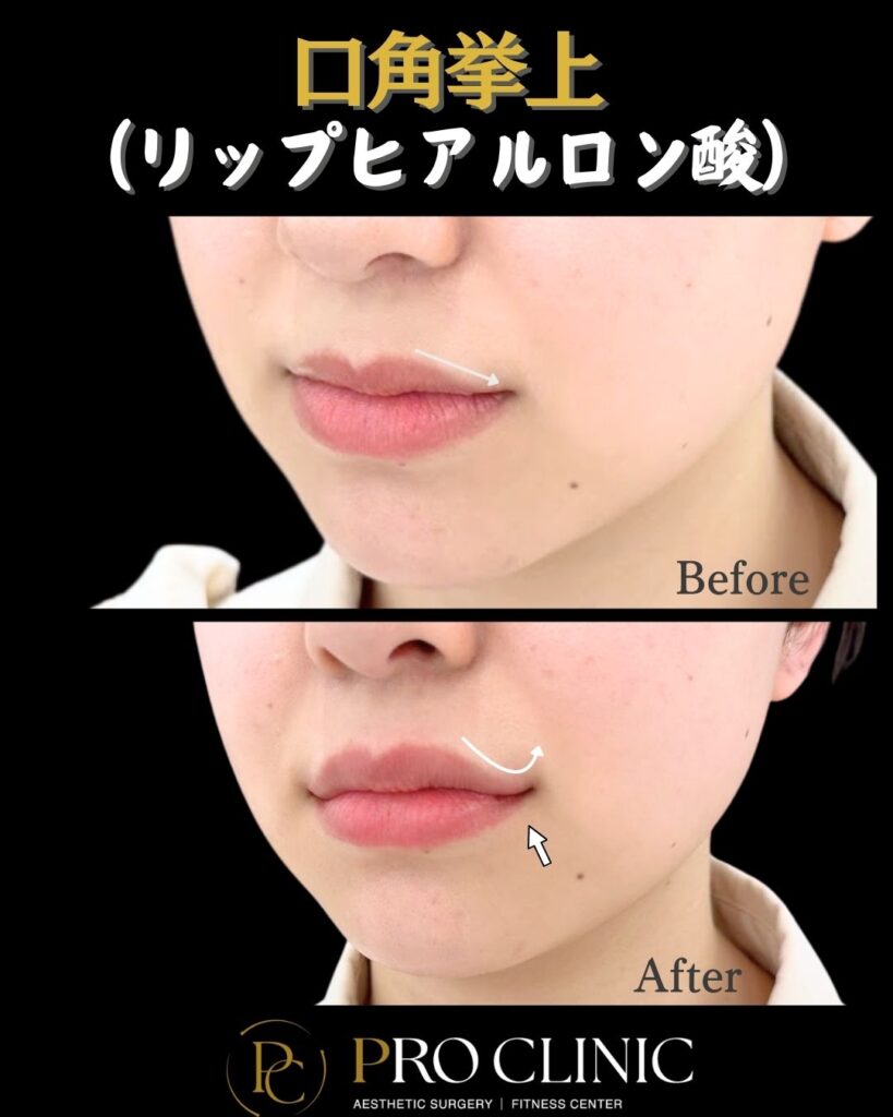 プロクリニックのリップヒアルロン酸による口角挙上の症例（1か月後・斜角）