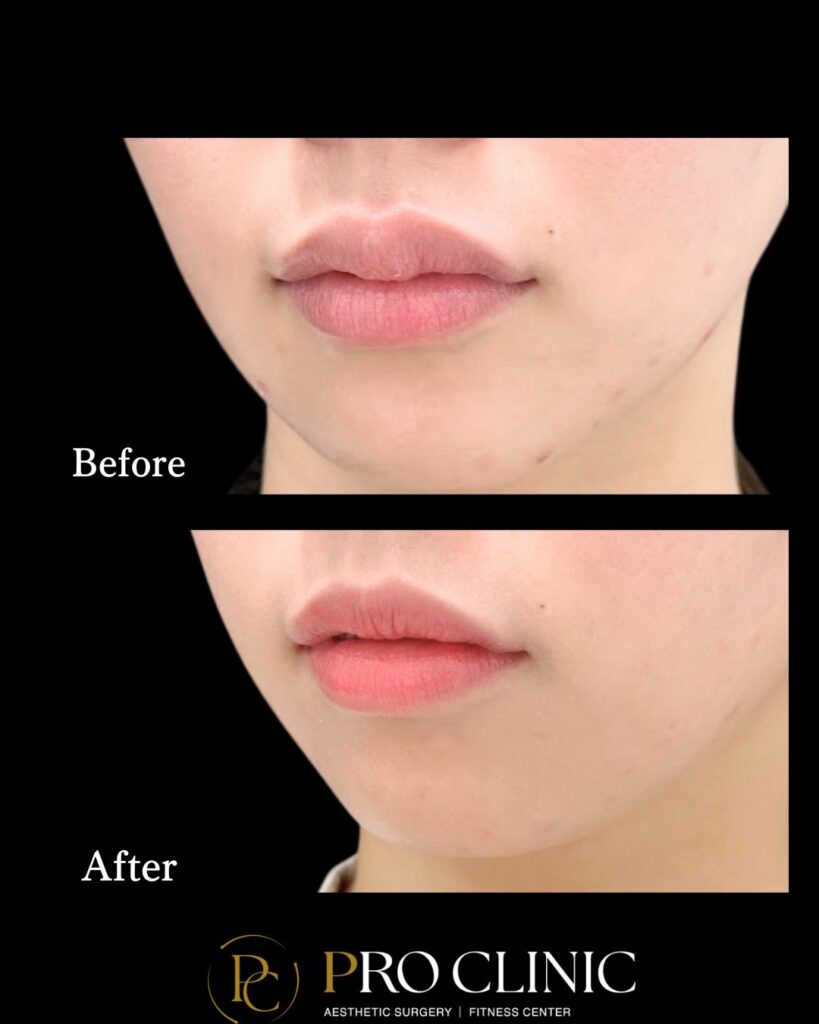 プロクリニックのヒアルロニダーゼの症例(1か月後・唇・斜角)