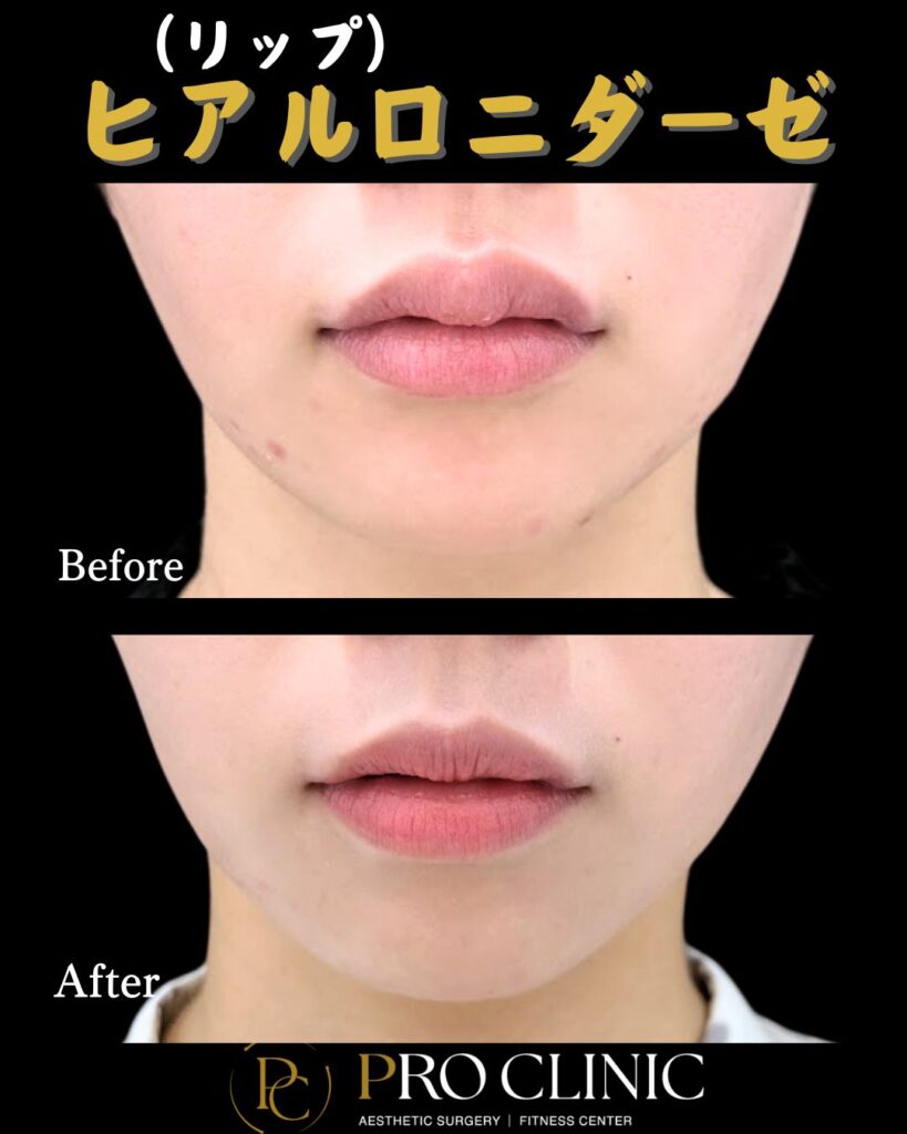 プロクリニックのヒアルロニダーゼの症例（1か月後・唇・正面）