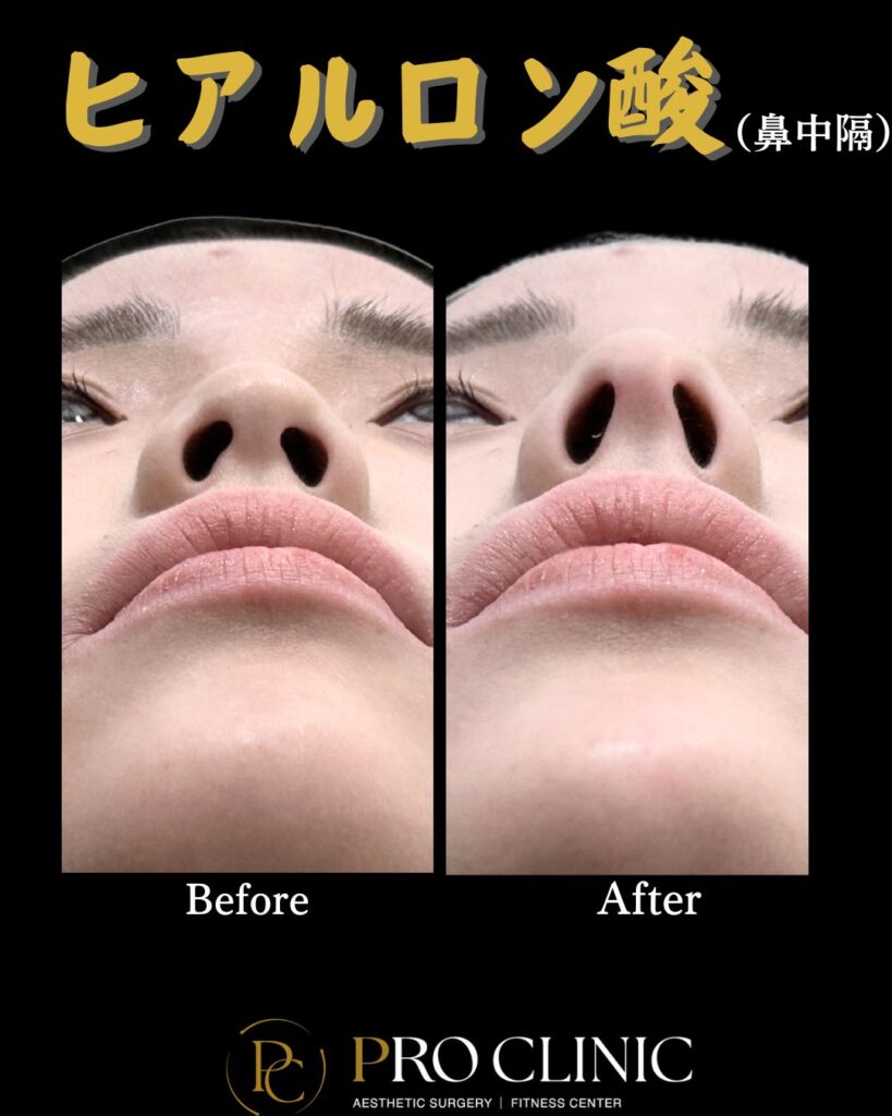 プロクリニックの鼻中隔ヒアルロン案注入の症例（１か月・正面）