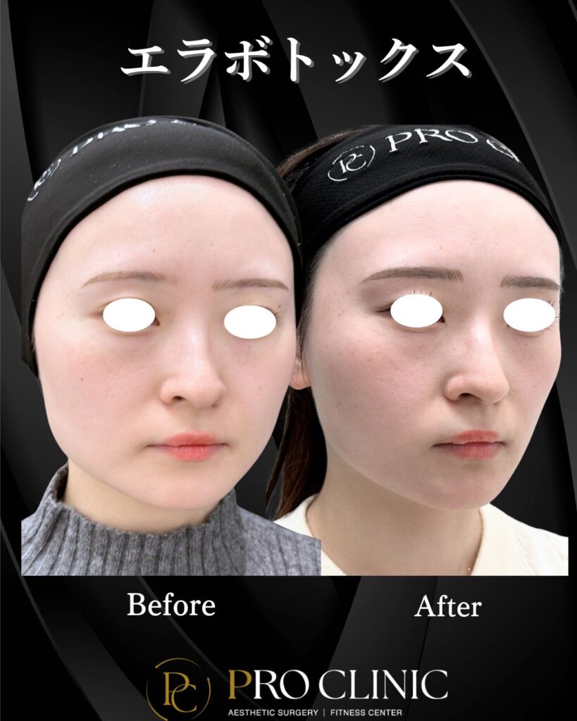 プロクリニックのエラボトックスの症例（1ヶ月後・斜角）