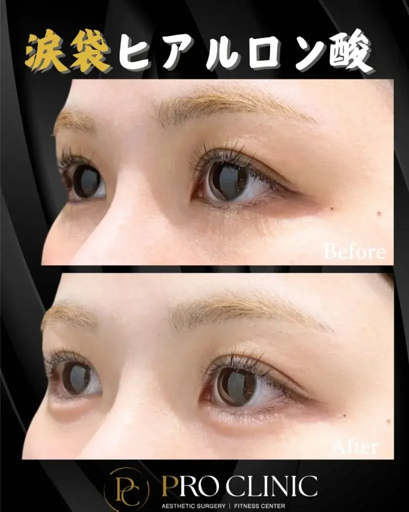プロクリニックの涙袋ヒアルロン酸の症例（斜め）。施術前（Before）と比較し、施術後（After）は涙袋が自然にふっくらとし、目の下の影（クマ）も改善され、目元の印象が明るくなっている。