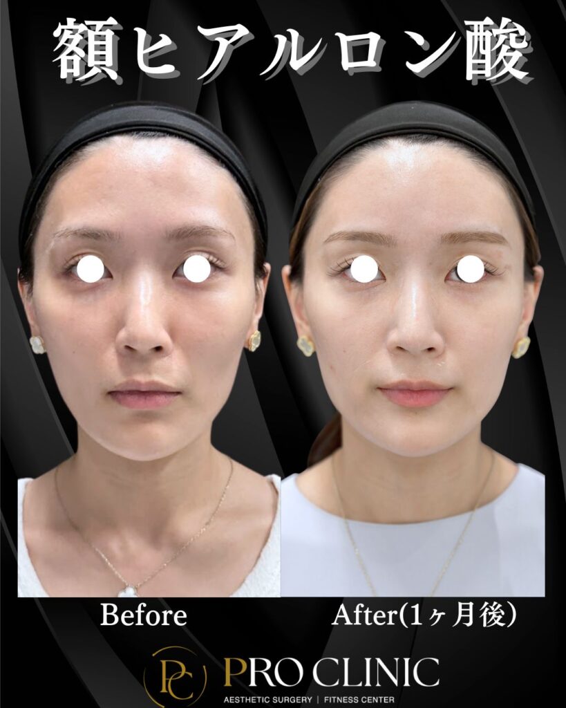 プロクリニックの額ヒアルロン酸注入の症例（1か月後・正面）