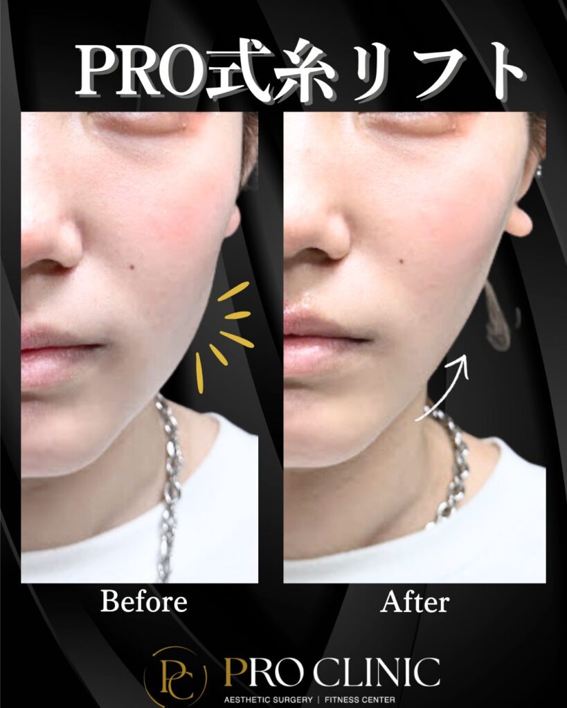 プロクリニックのPRO式糸リフトの症例（1か月後・正面）