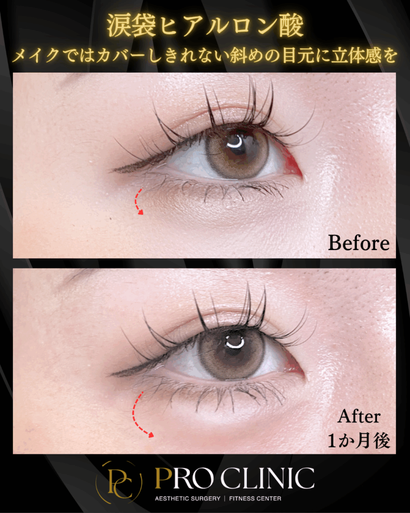 プロクリニックの涙袋ヒアルロン酸注入の症例写真(1か月後)。施術前(Before)の目尻下の影が、施術後(After)にはふっくらと改善され、立体感のある目元になった様子。