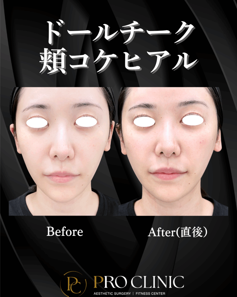 プロクリニックの頬コケヒアルロン酸注入の症例(直後・正面）