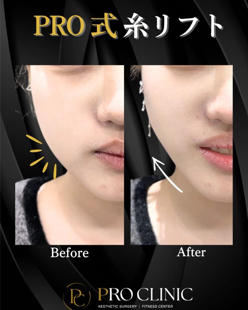 プロクリニックのPRO式糸リフトの症例（1か月後・正面）