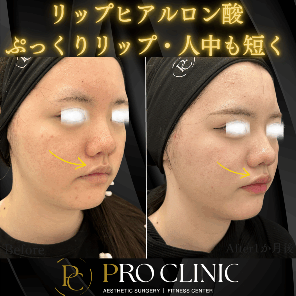 プロクリニックのリップヒアルロン酸注入の症例(1か月後・斜角）